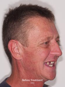 Before Treatment from the Side